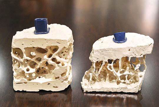 骨质疏松是缺钙引起的吗